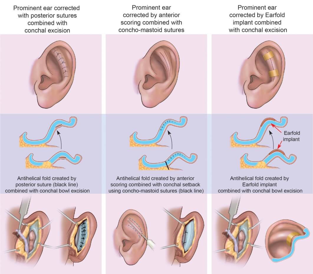 prominent-ear-correction-2.jpg