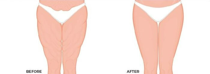 thigh-lift-before-after.jpg