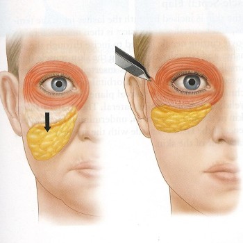 Facelift Surgery