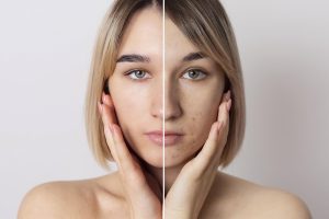 How Stress and Hormones Affect Skin Appearance