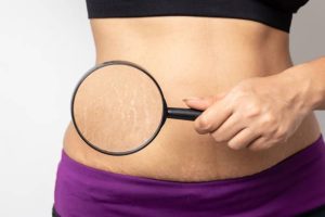 Managing Scarring After Fat Reduction Surgery