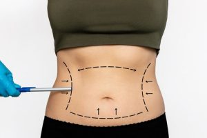 How Body Fat Distribution Affects Cosmetic Surgery Planning and Results