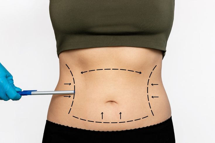How Body Fat Distribution Affects Cosmetic Surgery Planning and Results