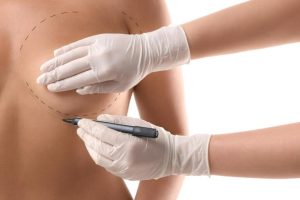 Types of Breast Surgery Procedures