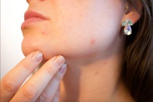 How Hormones Can Influence Skin Changes
